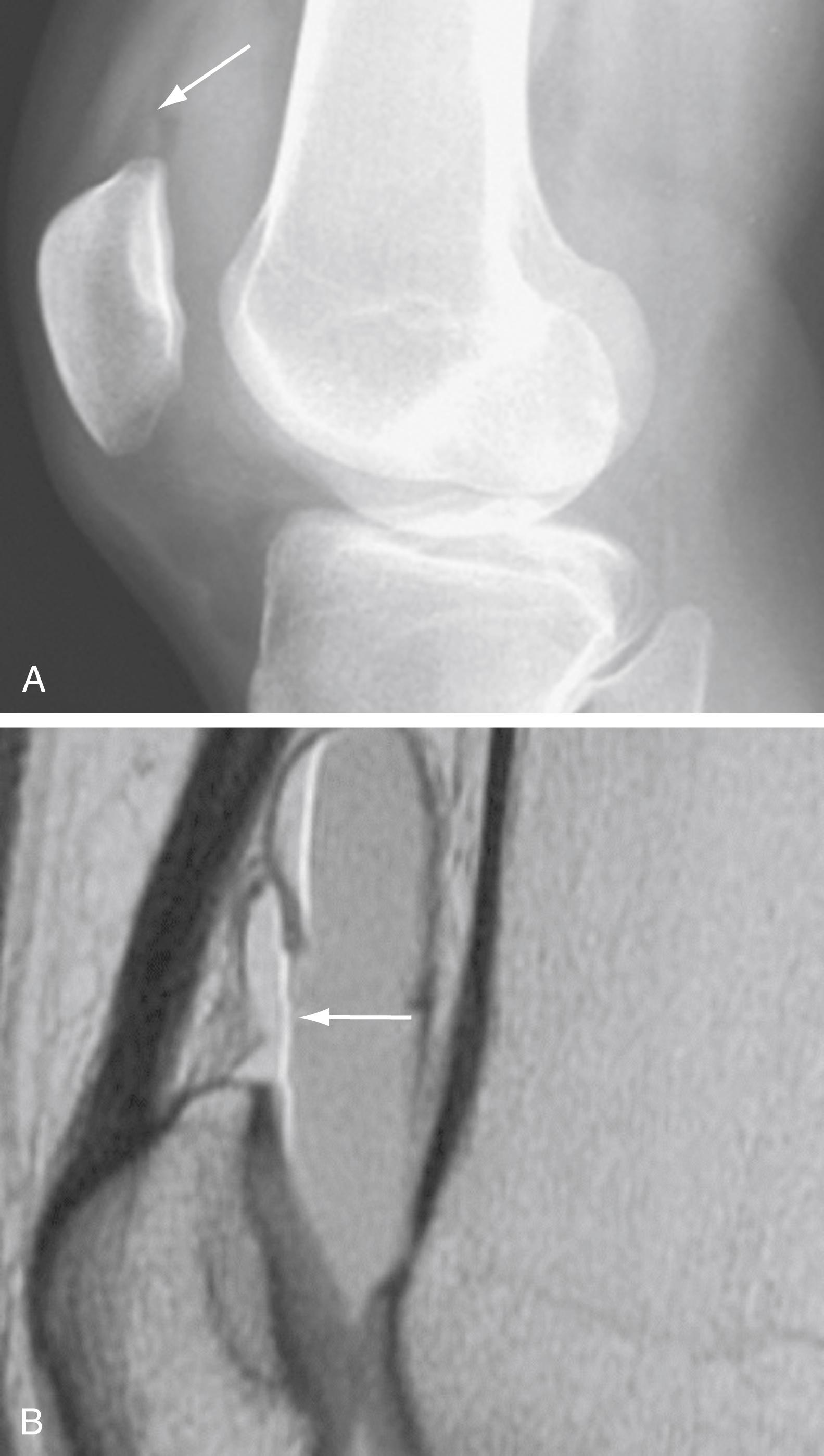 Fig. 48.4, Lipohemarthrosis.