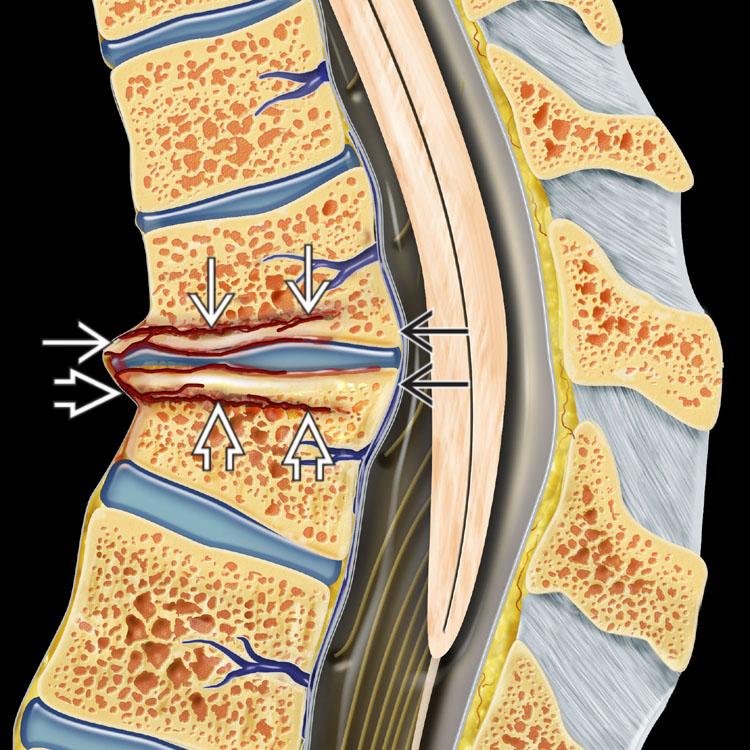 Compression Fracture