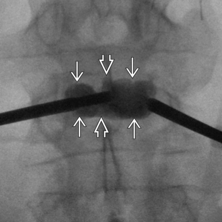 Cement Injection: AP View