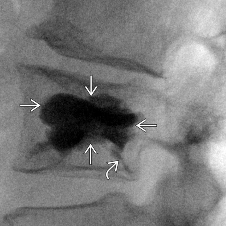 Kyphoplasty - Clinical Tree