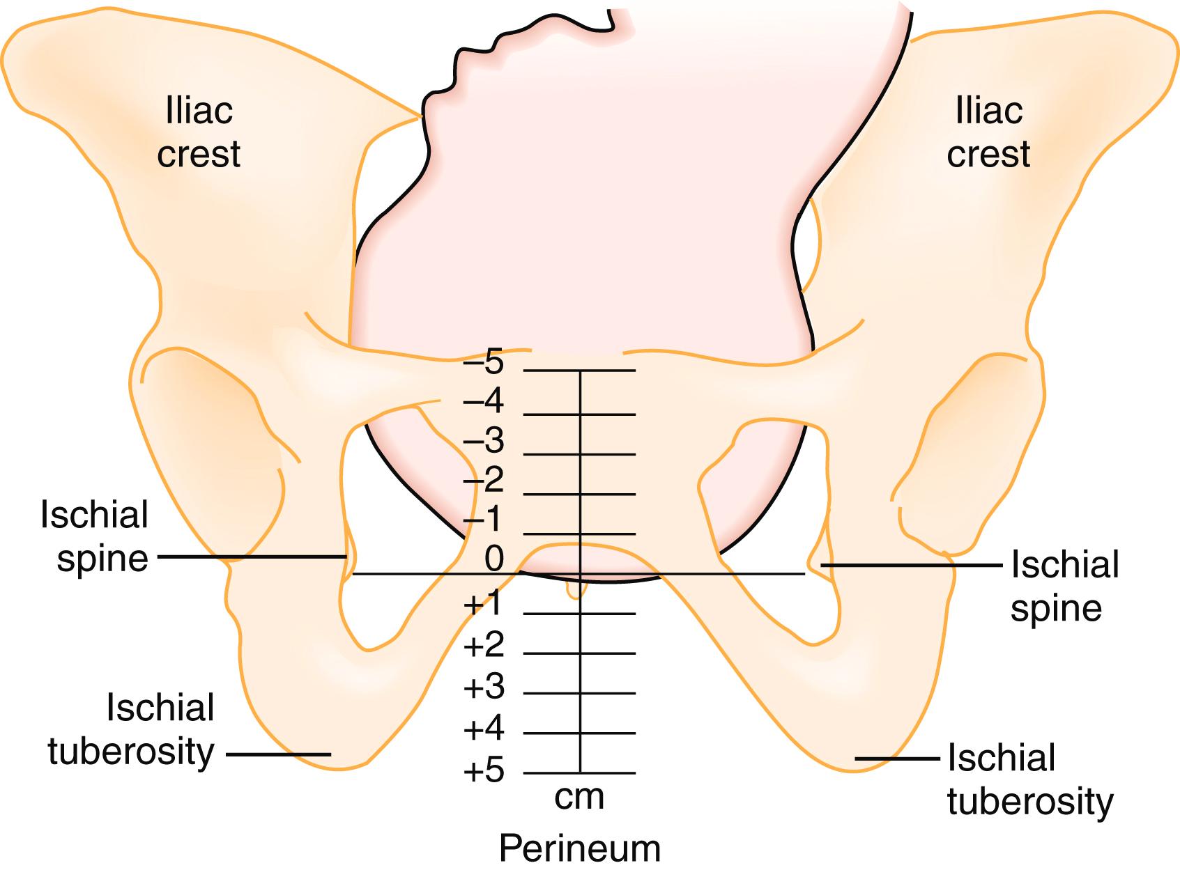 Fig. 176.4, Fetal stations. The level of the ischial spines is considered 0 station. The silhouette of the infant’s head is shown approaching station +1. (Courtesy Ross Laboratories, Columbus, OH.)