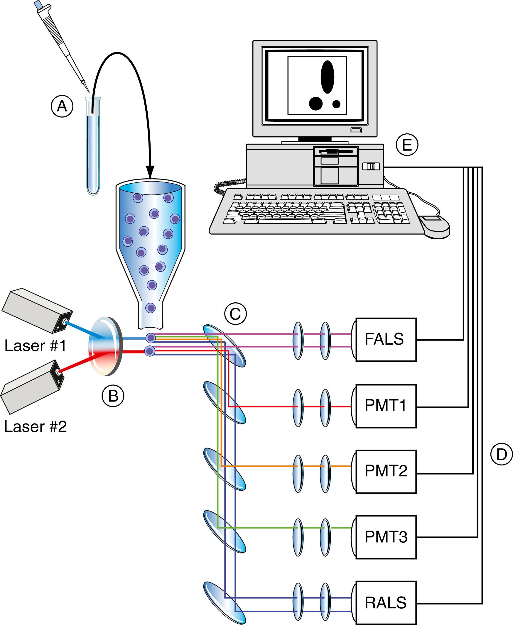 Figure 46.3, Structural components and function of the flow cytometer. A, Fluorochrome-labeled monoclonal antibody solutions are added to a cell suspension from peripheral blood, bone marrow aspirate, or a lymph node. The tubes are incubated at room temperature for a short period of time. B, Labeled cell suspensions are passed through the flow cell of a flow cytometer. Many flow cytometers are automated, but some models require the operator to process the tubes individually. More than 10,000 cells from each tube are typically analyzed to produce statistically valid information. C, Each cell passes individually through the highly focused laser beam of the flow cytometer, a process termed single-cell analysis . The fluorochrome of each labeled monoclonal antibody attached to the cell is excited by the laser light and emits light of a certain wavelength. The cells also scatter light at multiple angles. Photodetectors placed at forward and right angles to the axis of the laser beam collect the emitted or scattered light (photomultiplier tubes, PMT). Forward-angle light-scatter signals (FALS) and right-angle scatter signals (RALS), and as many as five fluorochrome signals, can be detected from each cell (multiparametric analysis). D, The signals from each photodiode are digitized and passed to a computer for storage, display, and analysis. Typically, all data recorded from each cell are stored for possible later recall for further analysis (list mode data storage). E, A variety of histograms for visual display can be generated automatically or at the discretion of the operator. List mode data can also be transferred to a separate computer for analysis. Presently, most commercial flow cytometers utilize a standardized file format for list mode storage, and a variety of computer programs are commercially available for data analysis and display.