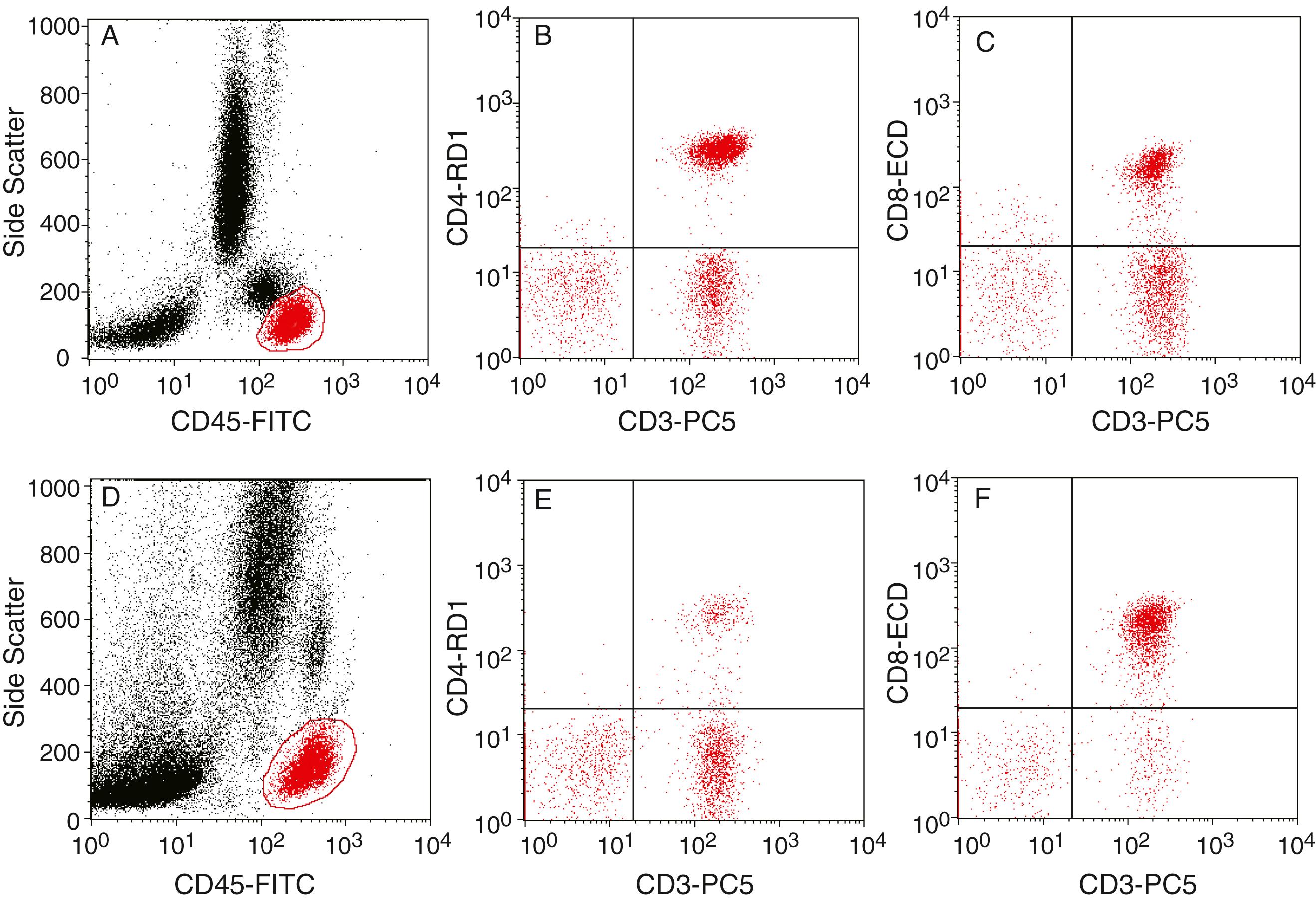 Figure 46.4, Flow cytometric immunophenotypic lymphocyte subset analysis. Use of four-color flow cytometry for the performance of peripheral blood lymphocyte subset enumeration. A, A dot-plot histogram of CD45 fluorescence intensity (CD45-FITC) versus side scatter (SS) as a gating strategy to discriminate lymphocytes (gated area) from other peripheral blood cells in a normal control individual. B and C, Dot-plot histograms of CD3 + CD4 + and CD3 + CD8 + cell populations. D through F, Corresponding histograms from a human immunodeficiency virus (HIV)-infected individual, demonstrating a marked decrease in CD4 + lymphocytes and the corresponding relative increase in CD8 + lymphocytes. Directly conjugated monoclonal antibodies were conjugated with fluorescein isothiocyanate (FITC), phycoerythrin (PE), energy-coupled dye (ECD), or a PE-Cy5 tandem (PC5).