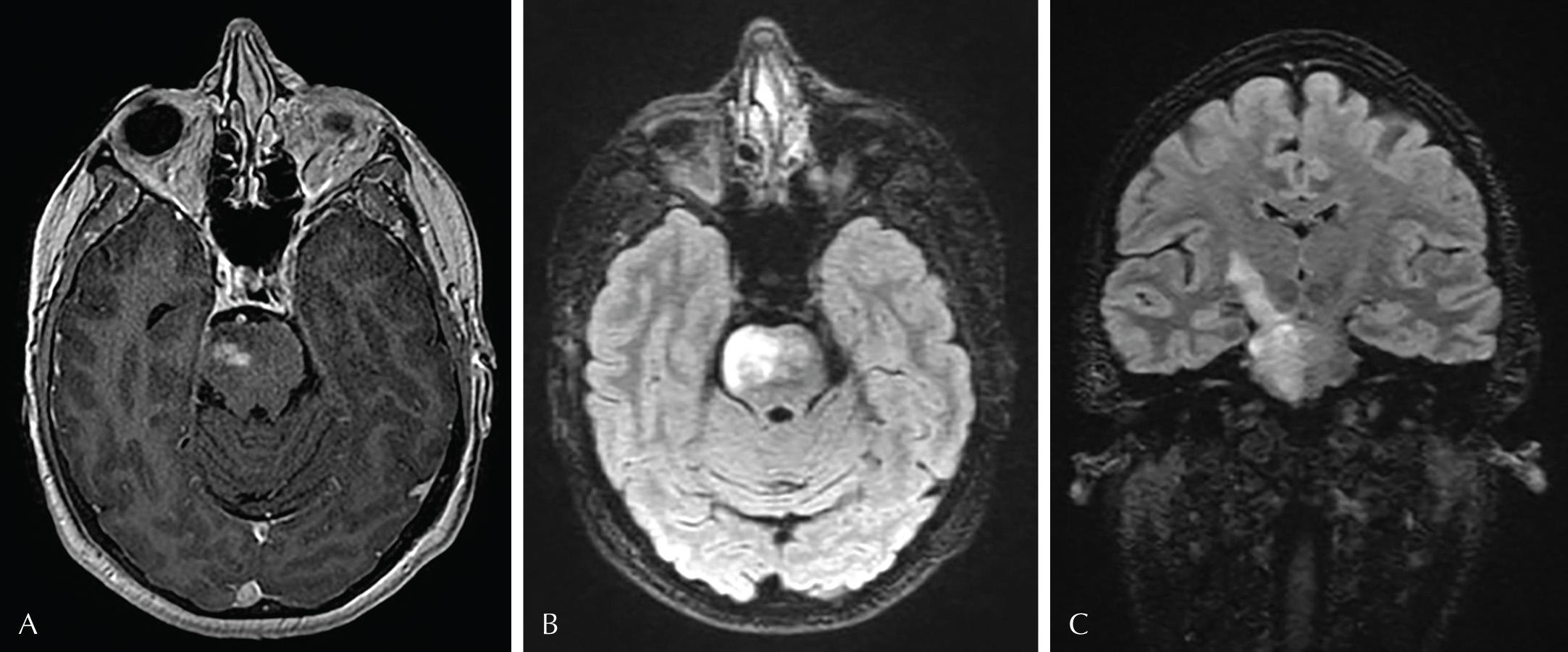 Fig. 2.1, Brain MRI with gadolinium demonstrating abnormal enhancement of the rights pons on axial T1 postcontrast images (A); T2 hyperintense signal within the body of the pons (B). The abnormality extends cranially along the corticospinal tract (C).