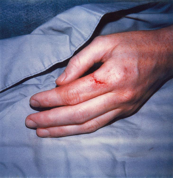 Fig. 140.1, Simple laceration.