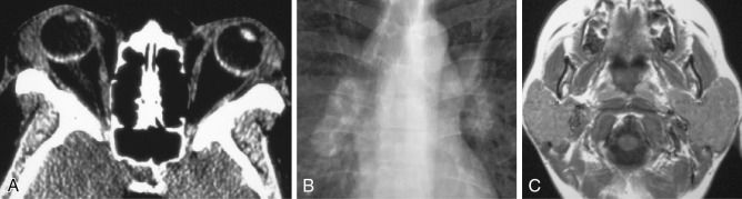 Lacrimal Gland Sarcoidosis Clinical Tree 