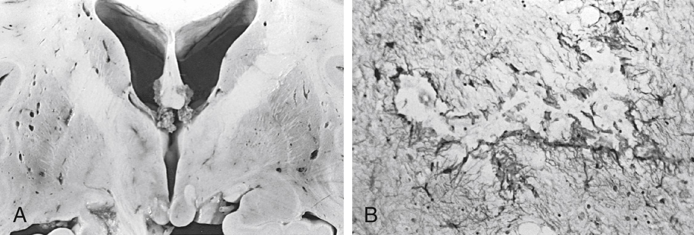 Fig. 27.1, État criblé. (A) Macroscopic coronal section. (B) Microscopic pathologic specimen. (Glial fibrillary acidic protein [GFAP] stain.)