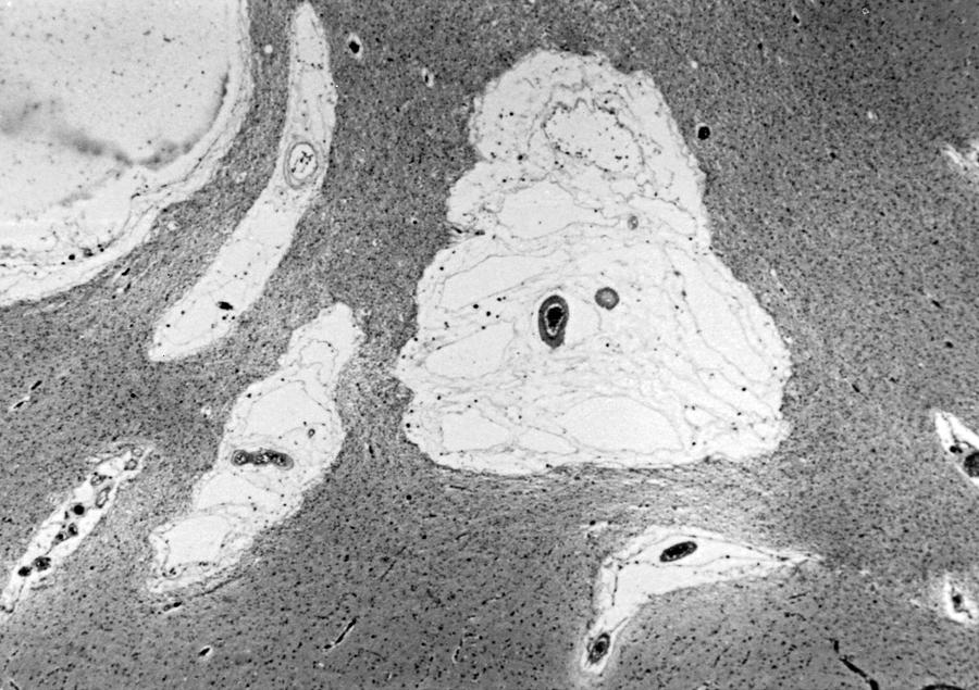 Fig. 27.2, Multiple enlarged perivascular spaces in the putamen of a patient with marked small blood vessel disease. (Hematoxylin and eosin, ×40.).