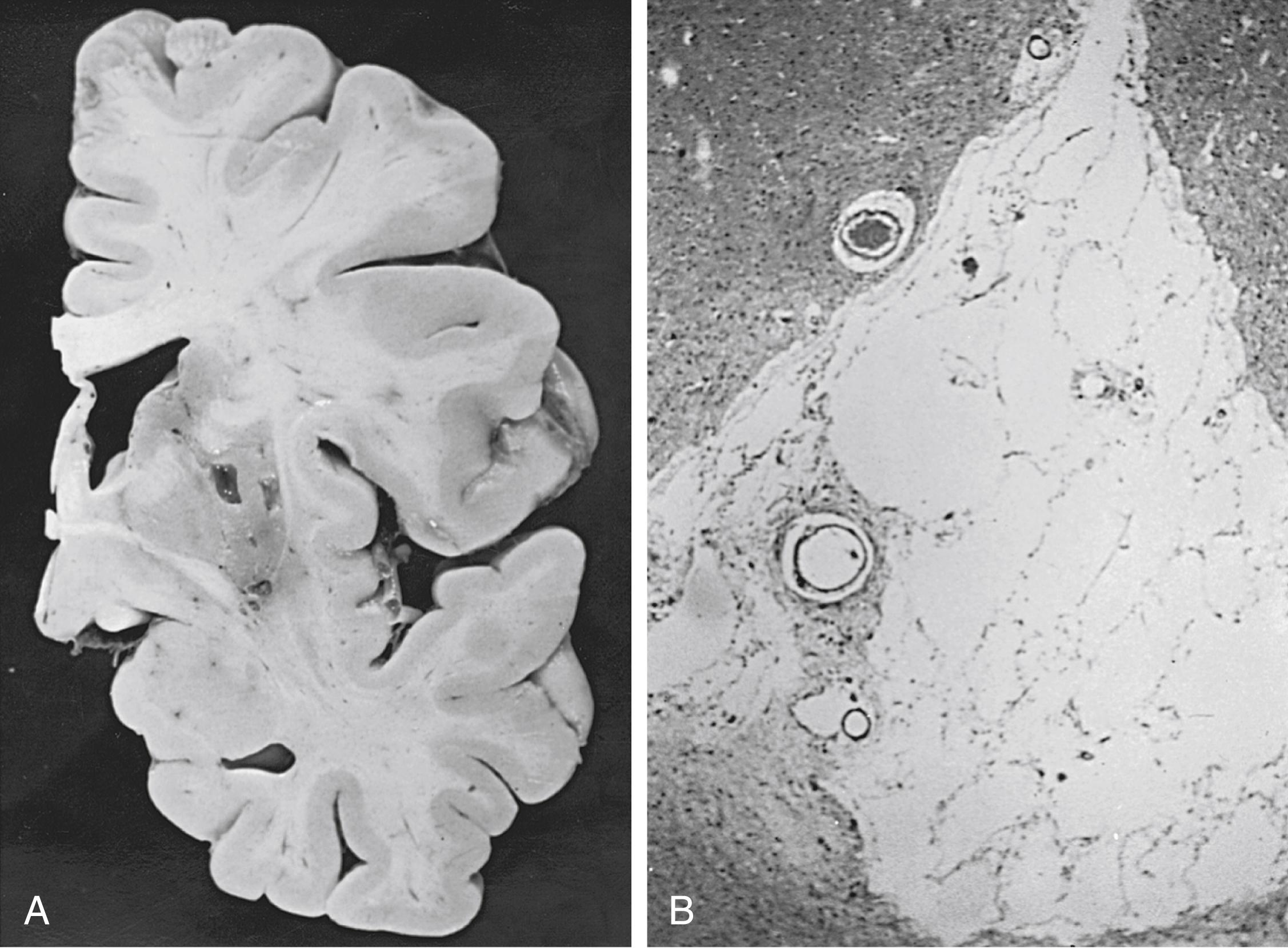 Fig. 27.3, Lacunes in the basal ganglia. (A) Macroscopic coronal section. (B) Microscopic pathologic specimen. (Hematoxylin and eosin stain.)