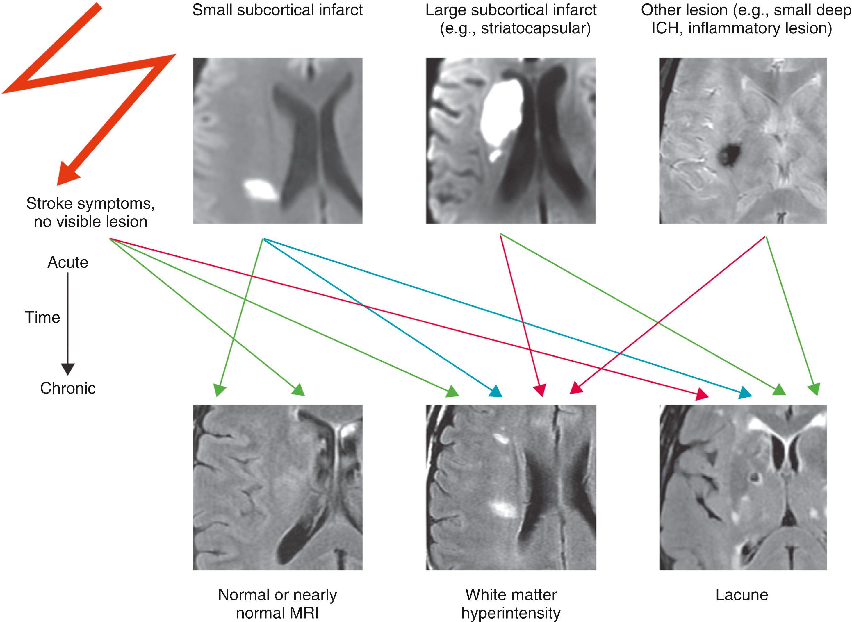 Fig. 27.6, Variable fates of lesions related to small-vessel disease and the convergence of acute lesions with different causes but similar late appearances on magnetic resonance imaging (MRI). ICH, Intracerebral hemorrhage.