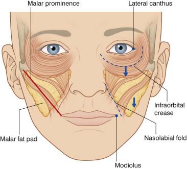 FIGURE 38.3, The mid-face and the malar fat pad. The mid-face region lies medial to the zygomaticus major muscle (red line). Gravitational aging of this region results from the descent of the malar fat pad, a roughly triangular-shaped formation of relatively fibrous subcutaneous fat.