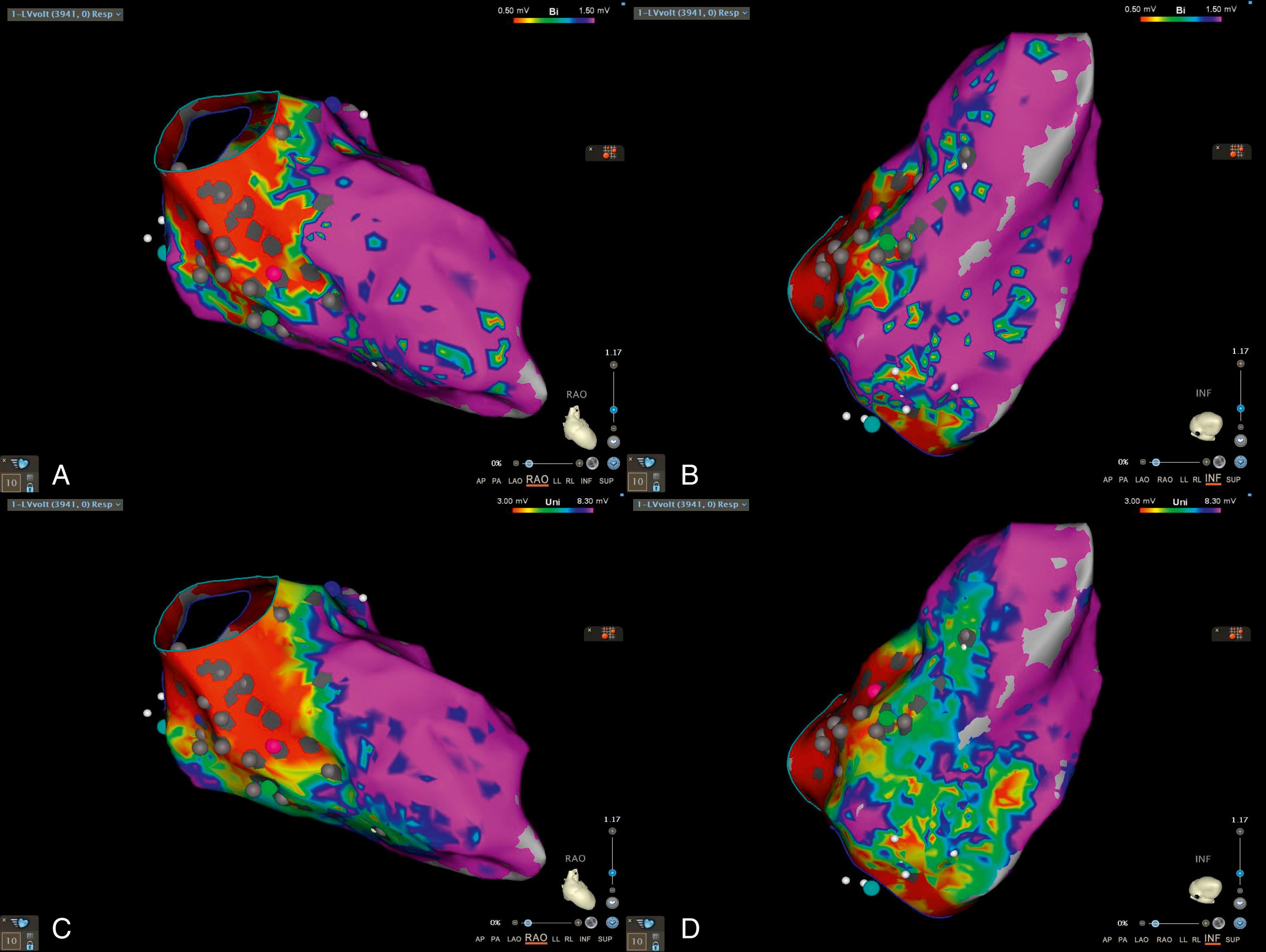 Fig. 88.1, (A–D) Left ventricular endocardial electroanatomic voltage maps and (E) multiple ventricular tachycardia (VT) morphologies from a patient with LMNA -related cardiomyopathy presenting with recurrent VT storm.