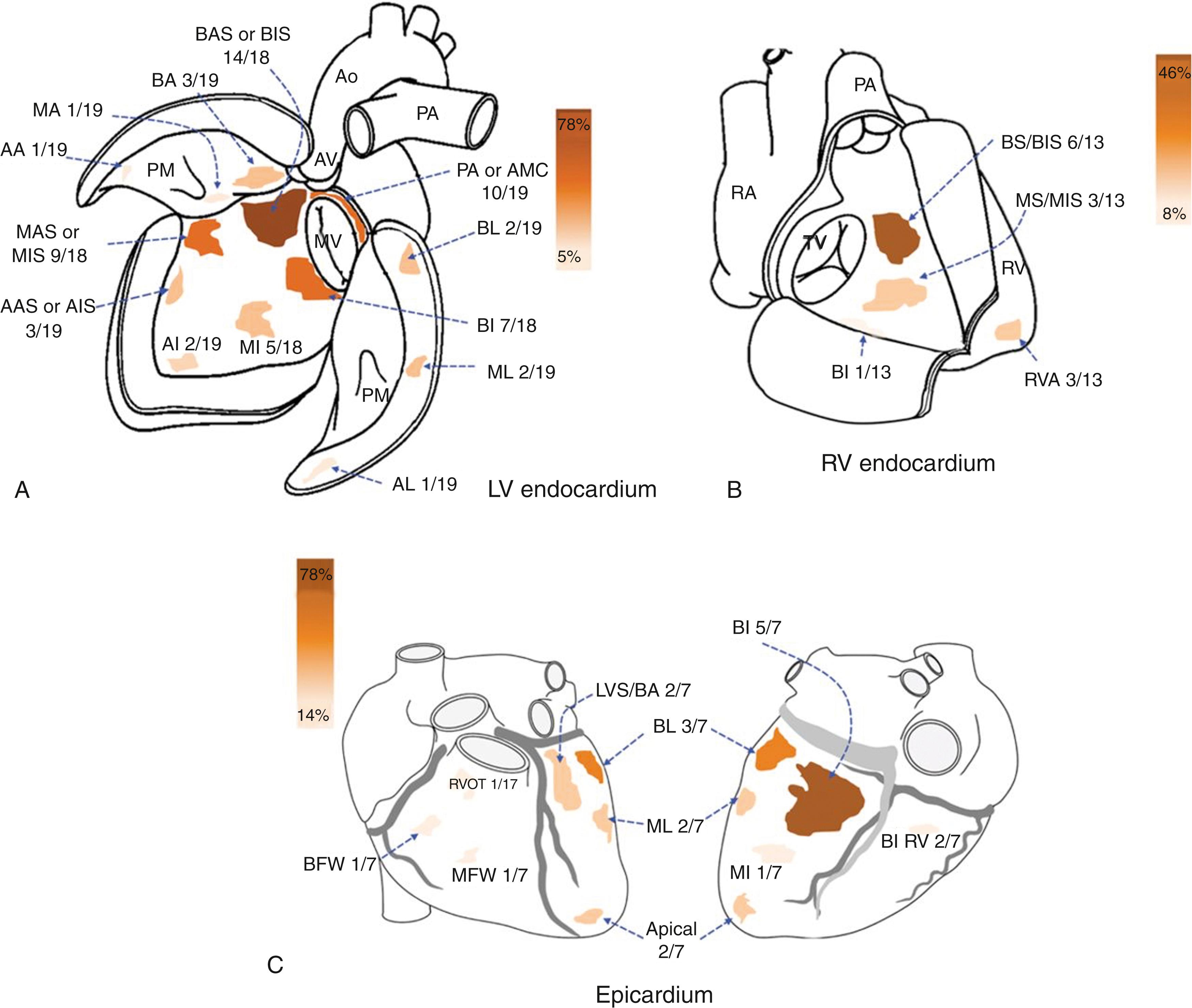 Fig. 88.2, Representation of the frequency of scar in patients with LMNA -cardiomyopathy who underwent electroanatomic mapping.