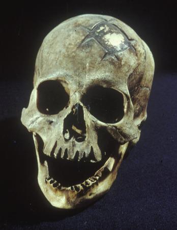 Figure 1.2, An early cranioplasty done with a gold inlay, which is well healed.