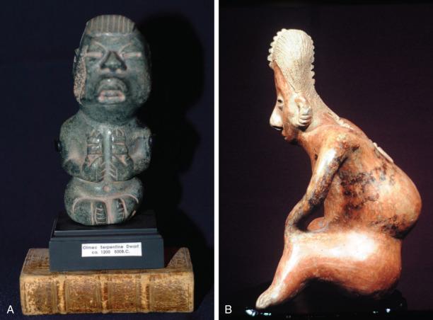 Figure 1.3, (A) A Jadeite figure from the Olmec culture of Pre-Conquest Mexico dating from about 1500 BC showing a figure of an achondroplastic dwarf with likely arrested hydrocephalus. Individuals with some deformations such as achondroplasia were highly prized in the noble courts. (B) A west Mexico figure from the Pre-Conquest Nayarit area showing a severe kyphoscoliosis in a young adult with likely a primary problem of a myelomeningocele.