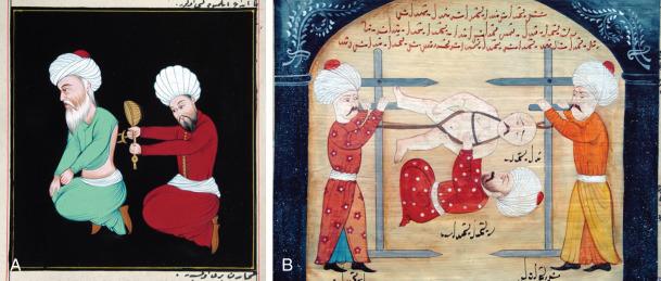 Figure 1.8, (A) Ottoman empire physician applying cautery to the back. (B) Manuscript leaf showing Avicenna reducing and stabilizing a spinal column injury.