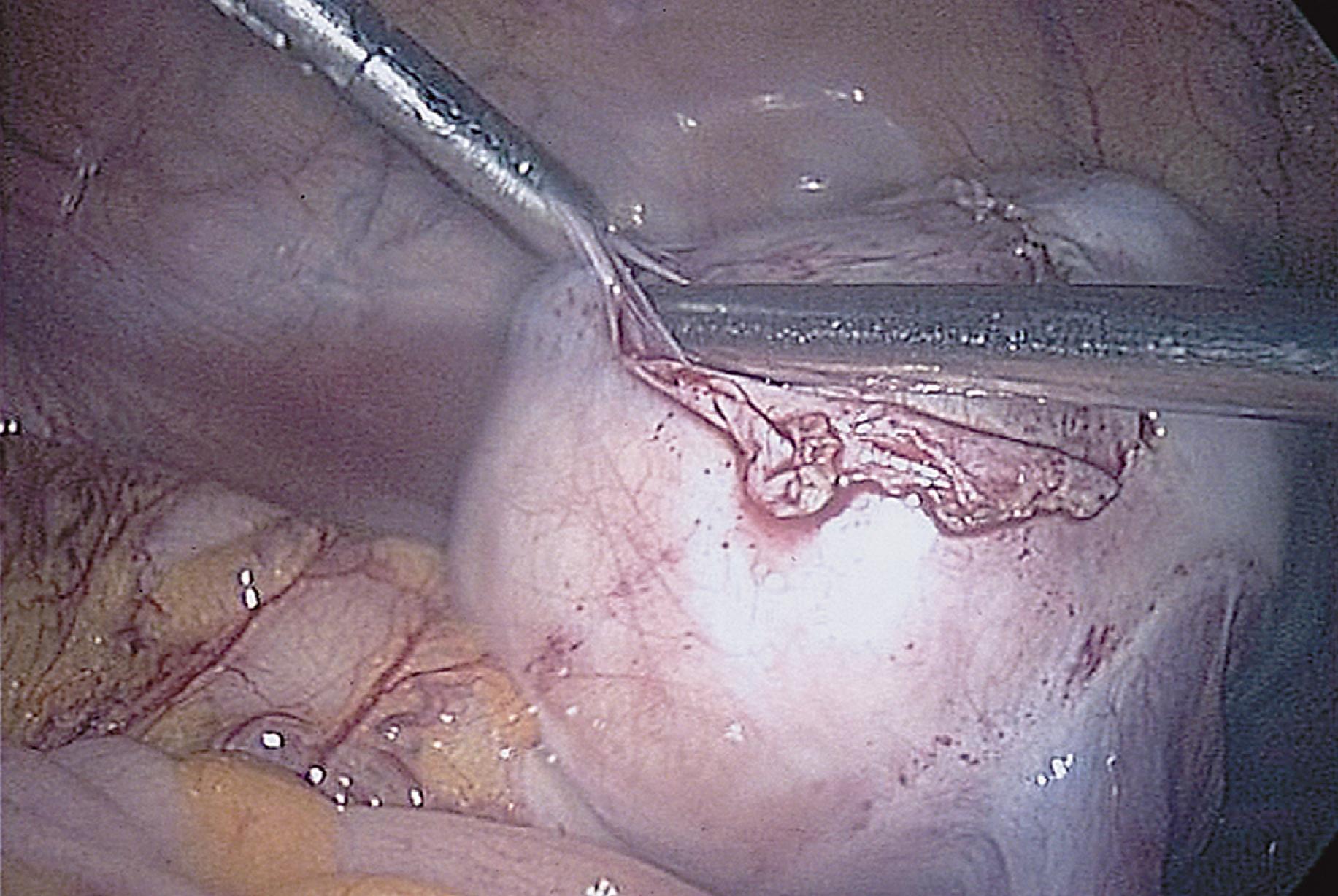 FIG. 115.2, A suction-irrigation device is used to get a plane of dissection between the cortex of the ovary and the cyst.