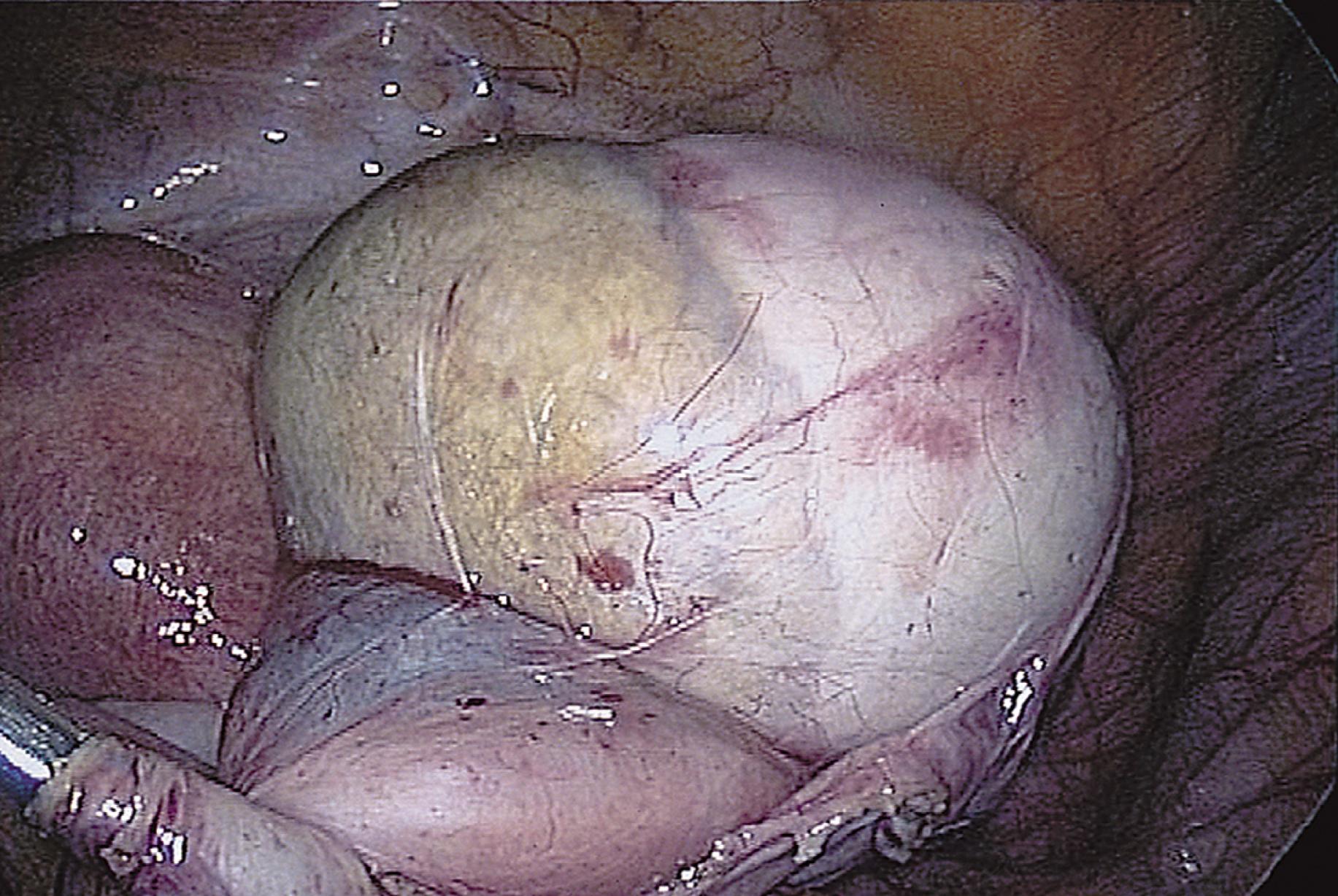 FIG. 115.3, The cyst is dissected from the ovary with a traction-countertraction technique.