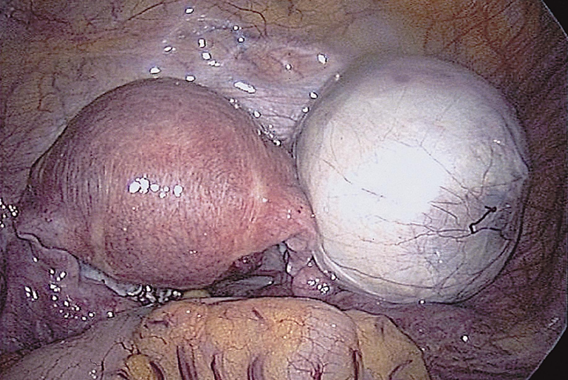 FIG. 115.4, The cyst is placed in the cul-de-sac so that the ovary can be inspected for bleeding.
