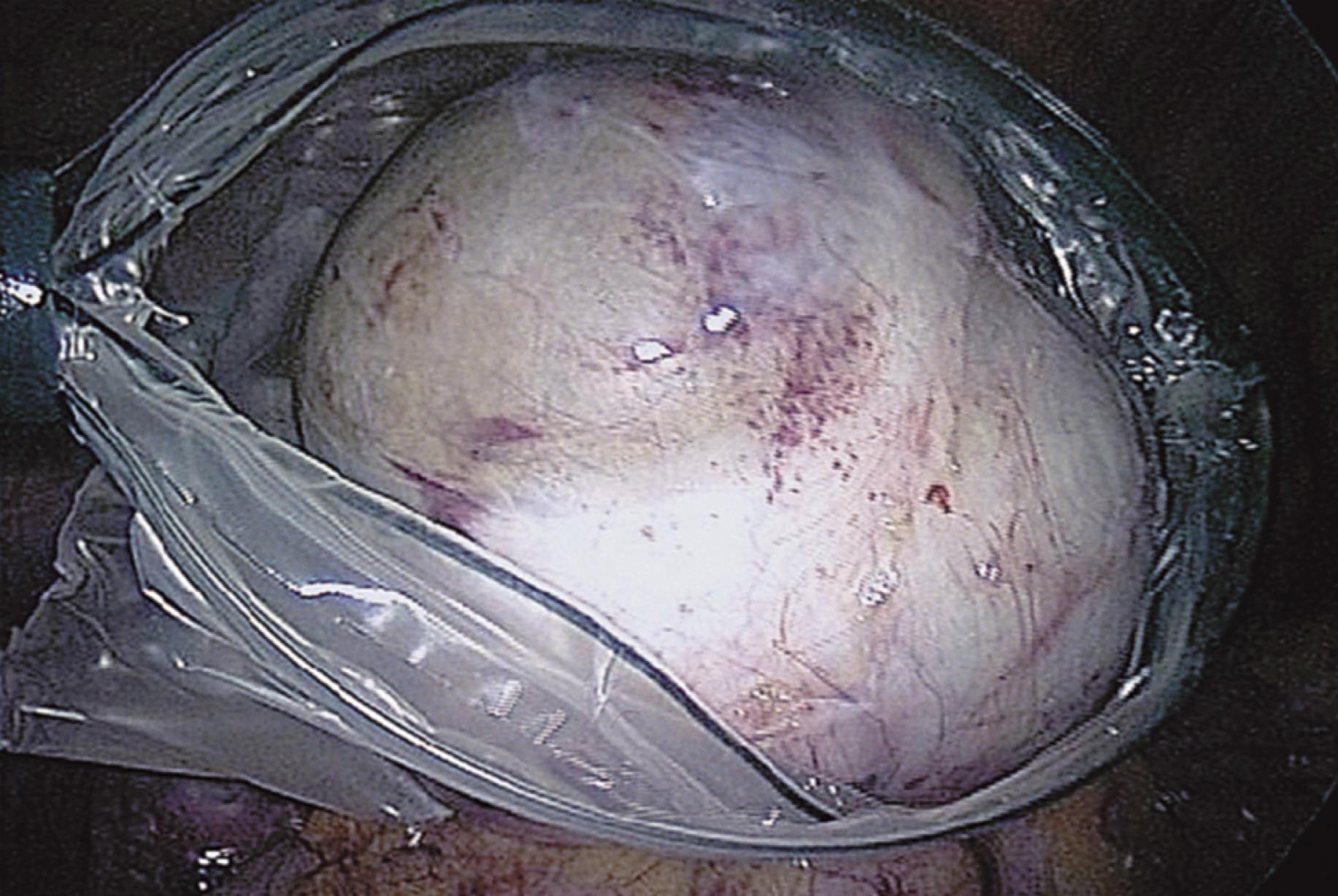 FIG. 115.5, The cyst is placed in the bag before removal.