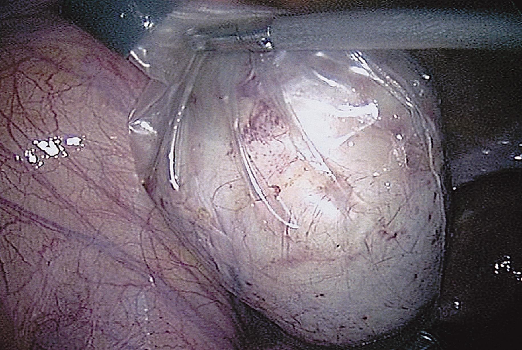 FIG. 115.6, The bag is brought through a port site. Most of the bag remains within the peritoneal cavity. The cyst is ruptured within the bag, the contents are suctioned, and the solid parts are removed in pieces.