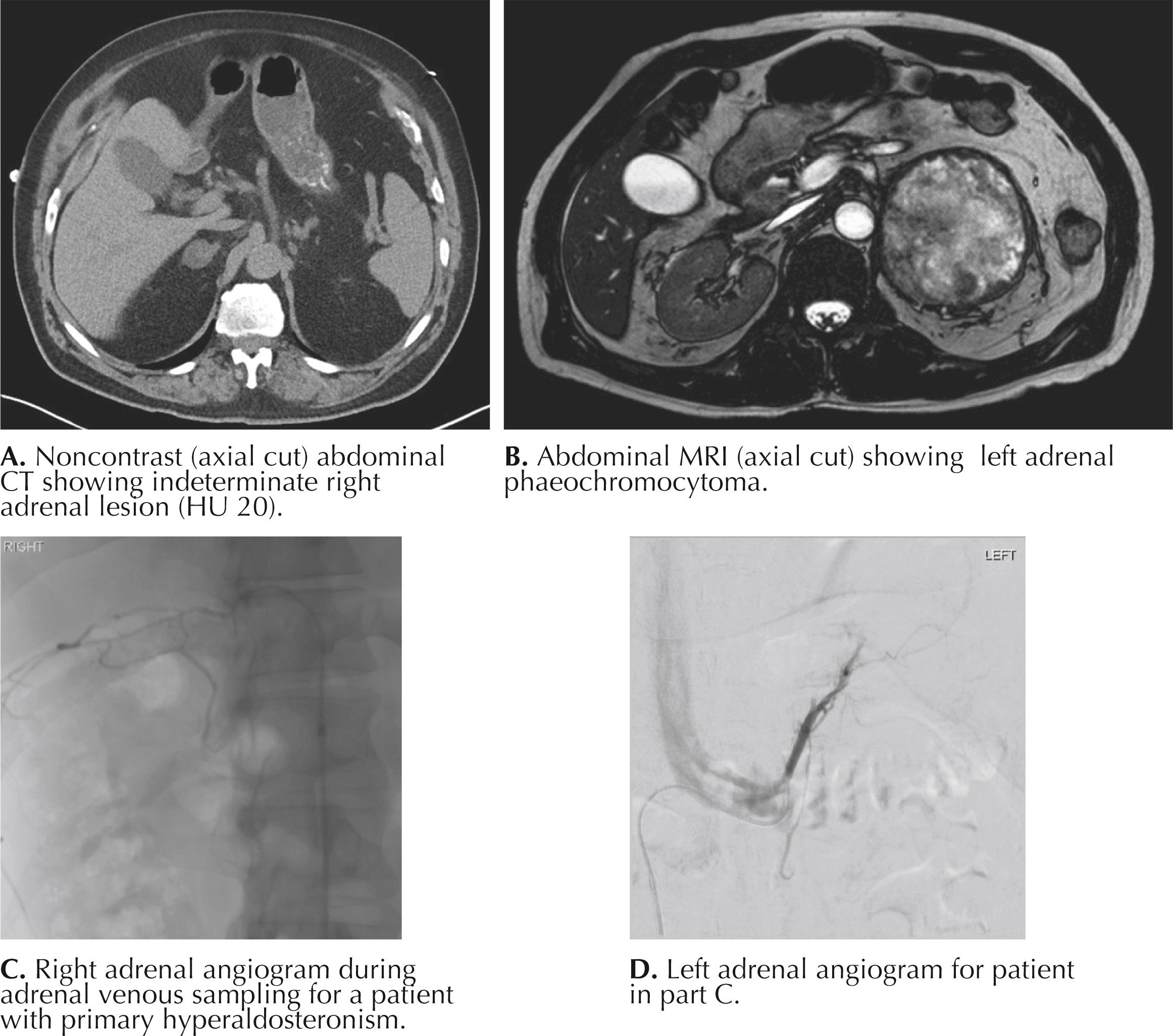 FIGURE 4.4, Adrenal gland in computed tomography (CT), magnetic resonance imaging (MRI), and positron emission tomography (PET).