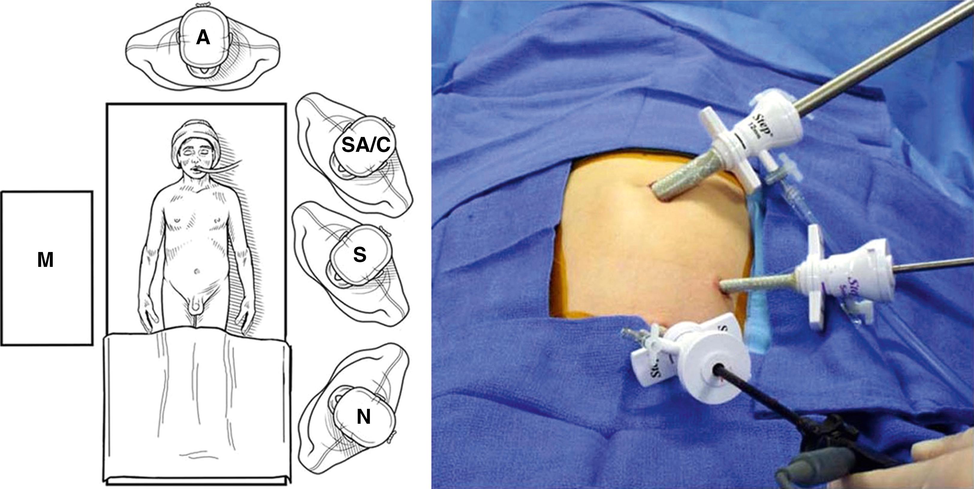 Fig. 10-1, The room and personnel setup is shown for a three-port laparoscopic appendectomy. The surgeon (S) stands to the left of the patient with the surgical assistant/camera holder (SA/C) standing caudal or cephalad (as shown) to the surgeon. The the scrub nurse is positioned either caudal to the surgeon or across the operating table. A, anesthesiologist; M, monitor. On the right is a photograph showing the typical port positioning. A 10-mm (or 12-mm) port is inserted through the umbilicus initially. This is the port in which the stapler and endoscopic retrieval bag (if used) are introduced and removed. The 5-mm telescope is introduced through the 5-mm left lower abdominal port. The surgeon works instruments placed through the umbilical port and the left suprapubic port.