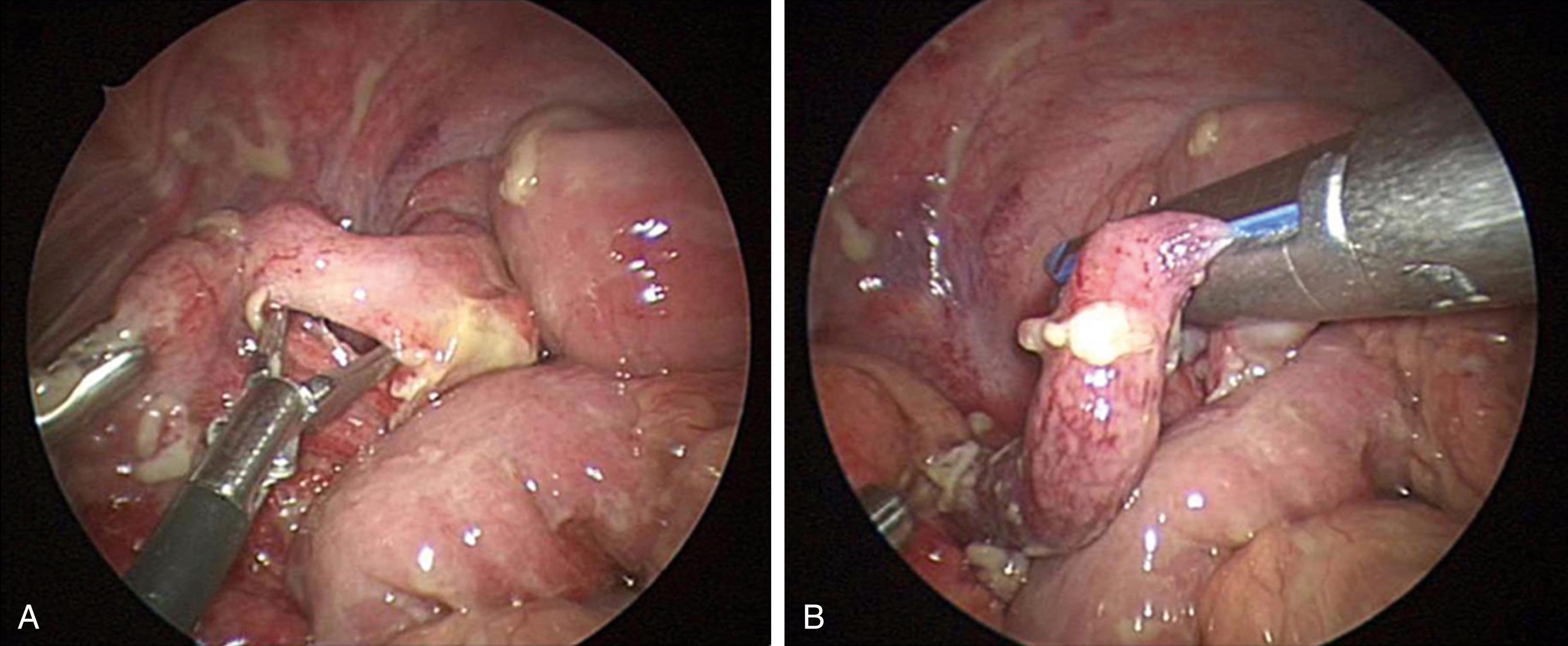 Fig. 10-2, A, Once the appendix has been freed from its inflammatory adhesions, a blunt dissecting instrument, usually a Maryland dissector, is used to develop a window in the avascular portion of the mesoappendix near the base of the appendix. B, If a stapler is used, it is introduced and positioned through this window across the base of the appendix. The appendix is usually ligated and divided first, although it is sometimes easier to initially ligate and divide the mesoappendix.