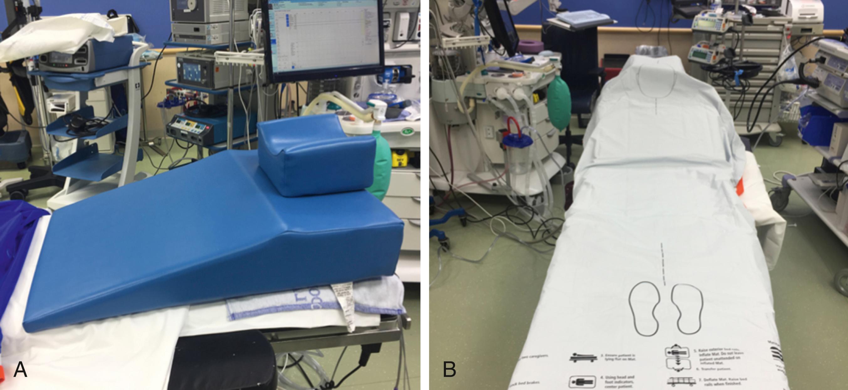 Fig. 25-1, Bed preparation for a vertical sleeve gastrectomy includes (A) Troop pillow and (B) Prevalon Mobile Air Transfer System (MATS).