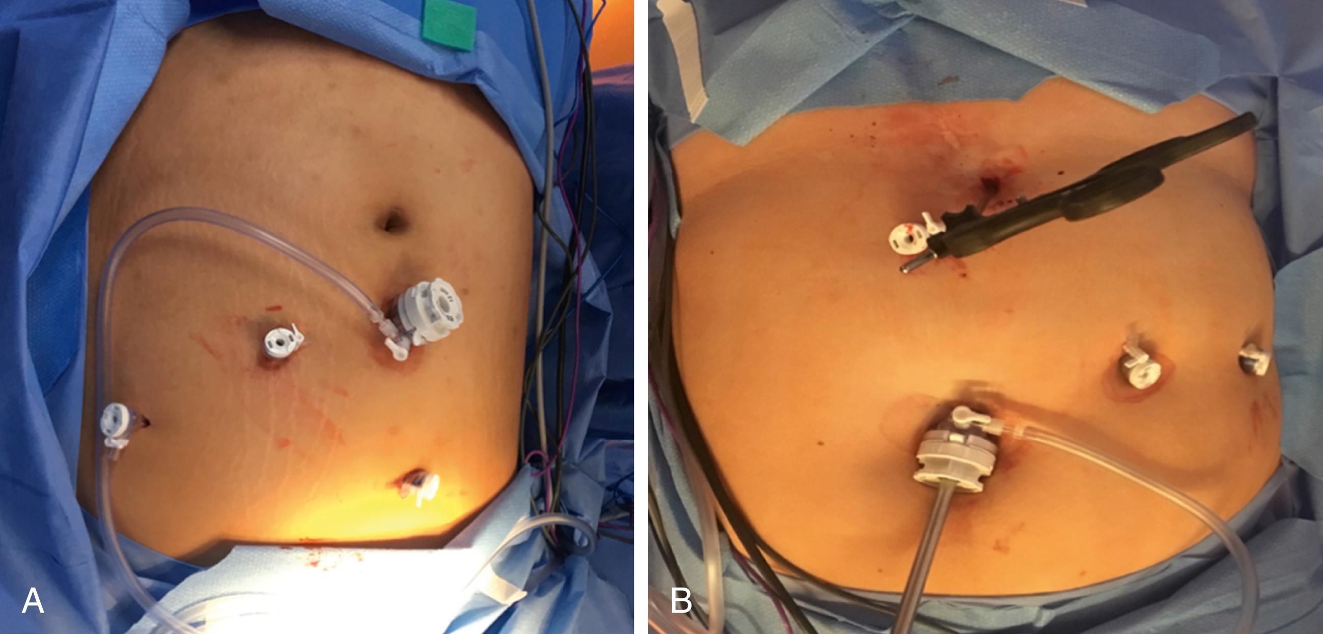 Fig. 25-2, A, One 12-mm and three 5-mm ports are inserted at the beginning of the case (patient head is toward the top). B, The patient’s head is directed to the top of the photo. A locking grasper, which serves as a liver retractor, has been introduced through a subxiphoid stab incision. Later in the case, a second 12-mm port is placed in the right midabdomen to accommodate the Standard Clamp (not seen in photo).