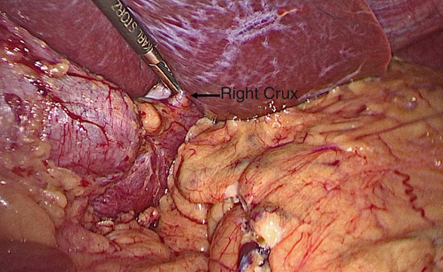 Fig. 25-3, Through a subxiphoid stab incision, a locking grasper slides below the left lobe of the liver to grasp the patient’s right crus and retract the liver.