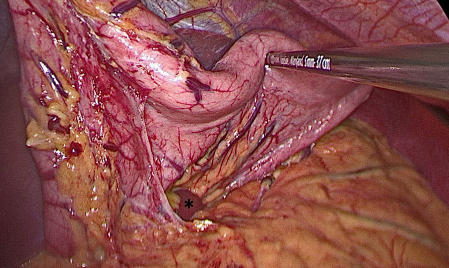 Fig. 25-5, The posterior attachments of the stomach have been taken down to provide complete mobilization of the stomach. The caudate lobe of the liver is often visible following gastric mobilization.