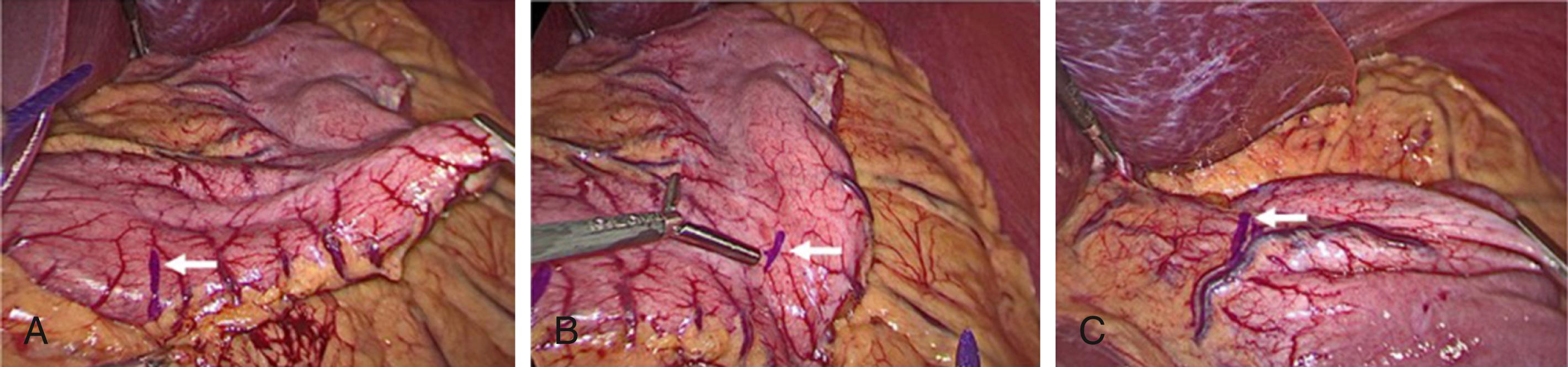 Fig. 25-6, Marking the anticipated staple line. White arrows point to the three markings. A, First marking is 6 cm from the pylorus along the greater curvature of the stomach. B, Second marking is 3 cm (a distance equal to the length between standard bowel grasper prongs) from the incisura angularis on the antrum. C, Third marking is 1 cm from the gastroesophageal junction adjacent to the angle of His.