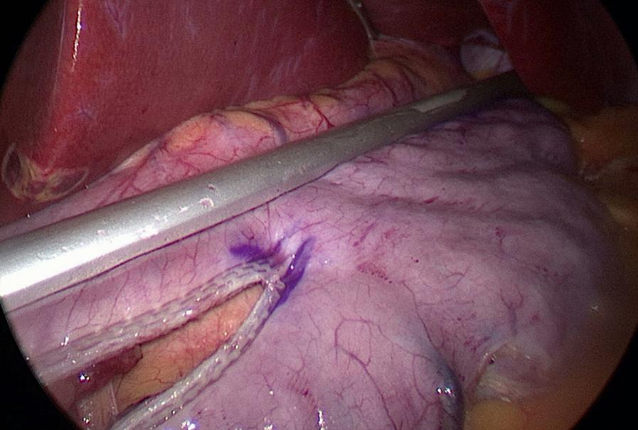 Fig. 25-8, The staple line runs adjacent to the Standard Clamp, beginning at the distal end of the stomach and extending to the gastroesophageal junction.