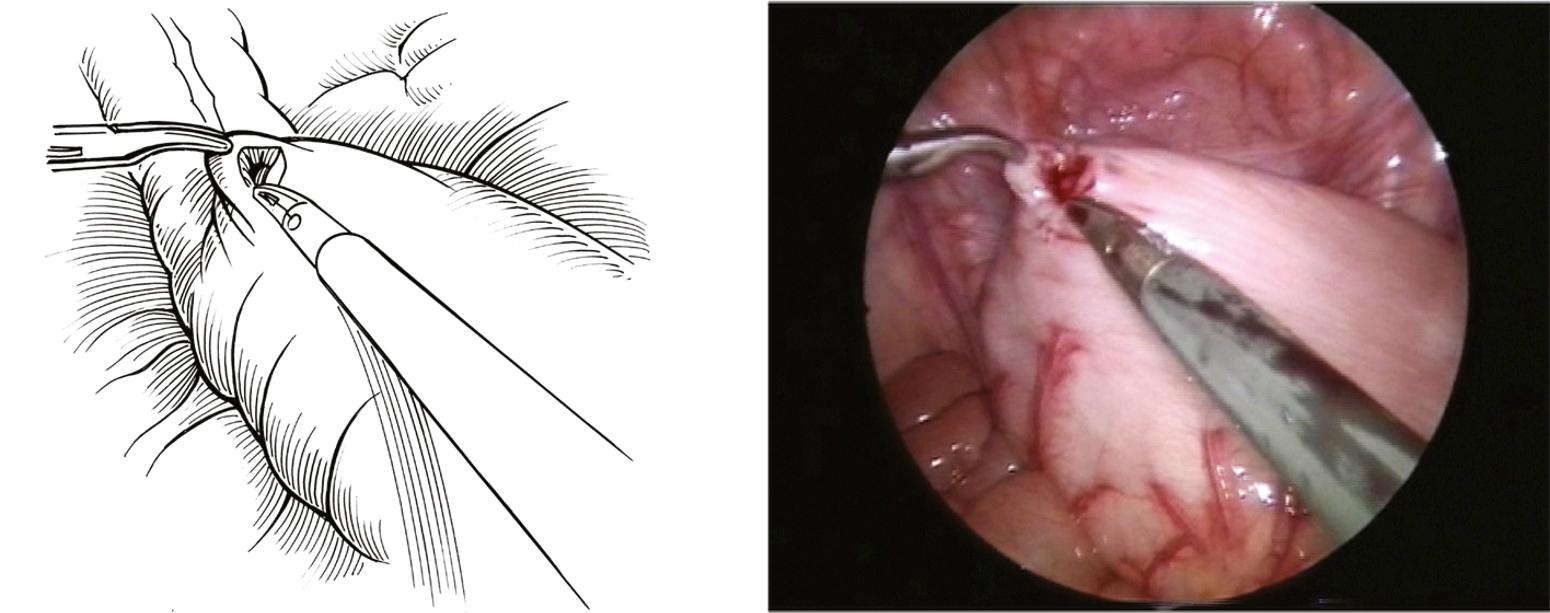 Fig. 15-1, Biopsies of the colon are important to determine the level of the transition zone. It is helpful to grasp the biopsy site with a fine-tip grasper (such as a Maryland dissecting instrument) and then to incise the serosa and muscularis sharply with scissors, as shown.