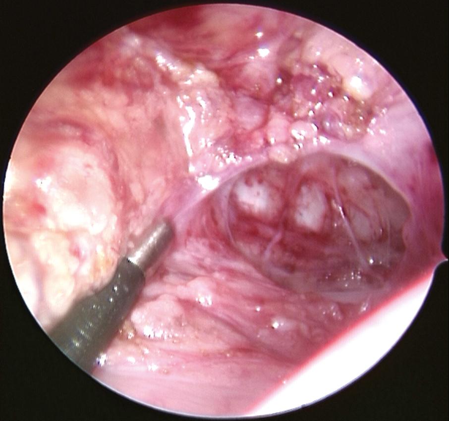 Fig. 15-2, This laparoscopic view shows that the retrorectal space has been opened and made ready for the Duhamel pull-through.