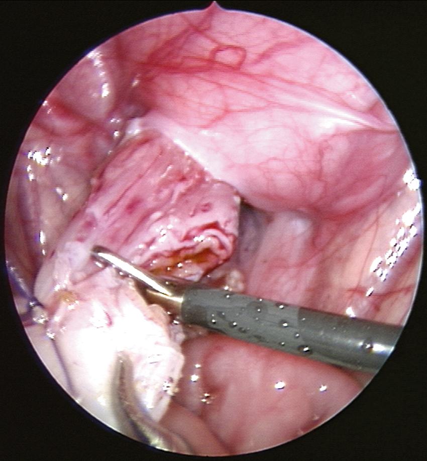 Fig. 15-3, While elevating the aganglionic rectum, the rectum is sharply transected approximately 2 cm above the peritoneal reflection. The anterior wall is usually incised first, followed by incision of the posterior aspect of the rectal wall.