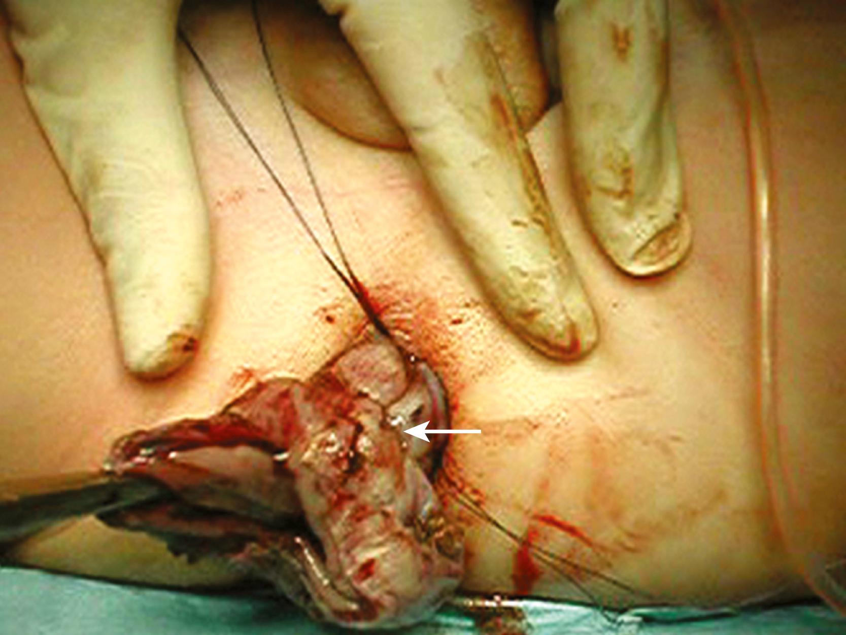 Fig. 15-4, This external view shows the mobilized colon being exteriorized through the anal incision to the point where the most proximal biopsy was taken ( arrow ). It is important to ensure that the pulled-through colon is not twisted and lies with its antimesenteric surface facing anteriorly.