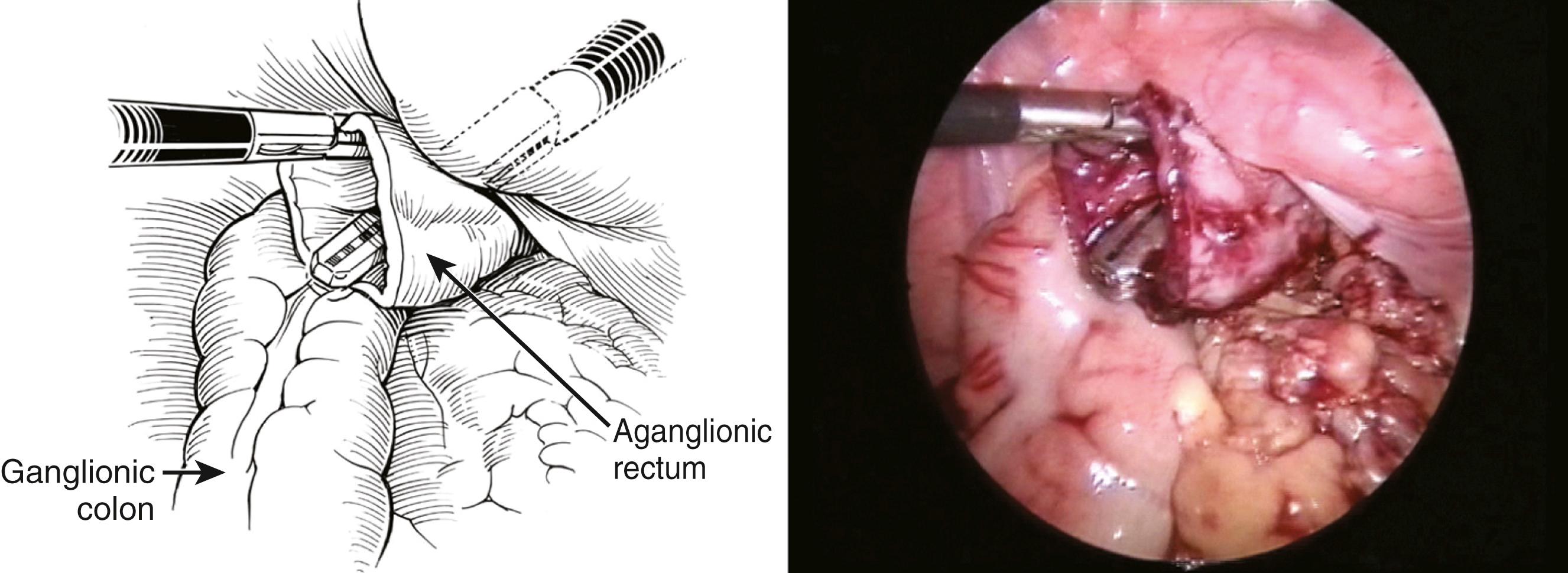 Fig. 15-6, From inside the abdomen, the correct position of the endoscopic stapler can be confirmed. In this view, the endoscopic stapler and the aganglionic rectal segment are visualized.