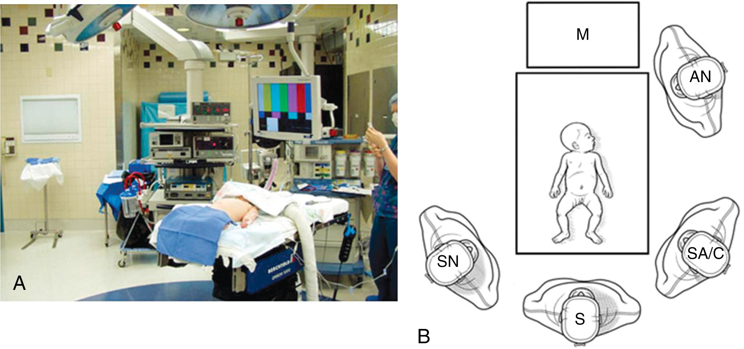 Fig. 2-1, For a laparoscopic fundoplication, the patient is placed supine on the operating table. A, Infants and young children are positioned at the foot of the bed in a frog-leg position, and the foot of the bed is dropped. B, The surgeon (S) and surgical assistant/camera holder (SA/C) stand next to the patient at the end of the bed. The surgical assistant is to the right of the surgeon and the scrub nurse (SN) is to the surgeon’s left. A single monitor (M) is used and is positioned over and cephalad to the patient’s head. AN, anesthesiologist.