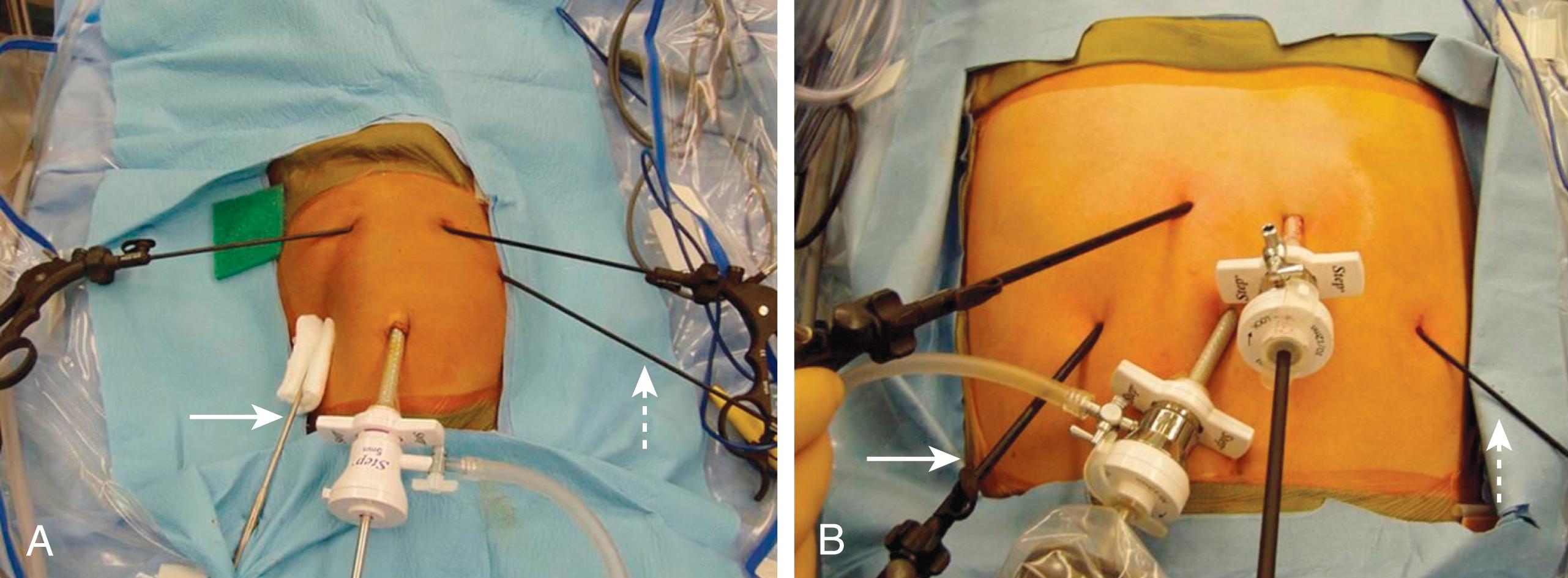 Fig. 2-2, There are a number of ways to orient the instruments when performing a laparoscopic fundoplication. With our technique, the 45-degree angled 5-mm telescope is introduced after insertion of the 5-mm umbilical cannula. The liver retractor is introduced in the patient’s right subcostal region ( solid arrow ). The two main working ports are in the left and right epigastrium. The main working port for the surgeon is the one in the patient’s left epigastric region. It is through this incision that dissecting instruments, needle holder, and suture are introduced. The instrument used by the surgical assistant is in the patient’s left subcostal region ( dashed arrow ). The stab incision technique can be used for both infants ( A ) and adolescents ( B ).