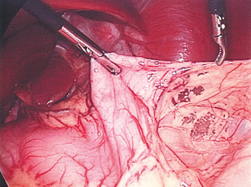 Fig. 2-3, The initial operative step is to ligate and divide the short gastric vessels. This dissection starts at a point one-third of the way down the greater curvature of the stomach. The Maryland dissecting instrument attached to cautery is used for this purpose. The 3-mm sealer or the harmonic scalpel can be used in older children.