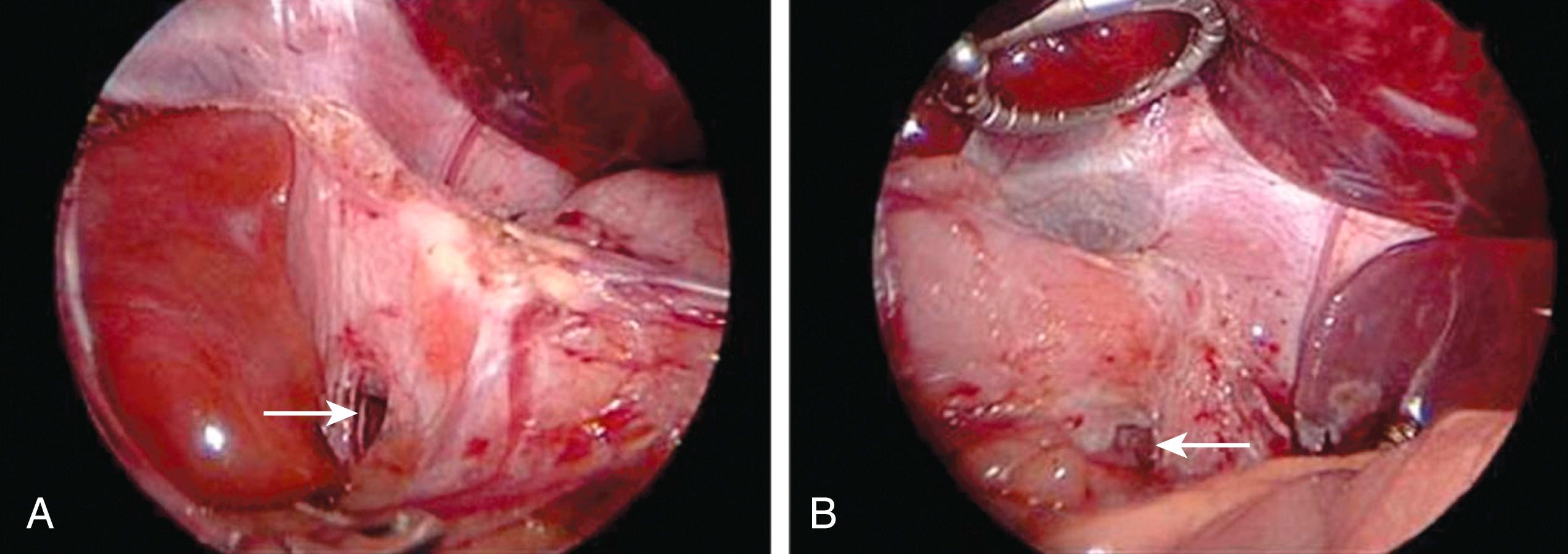 Fig. 2-4, If an adequate length of intra-abdominal esophagus is present, dissection should be minimal to help prevent migration of the fundoplication wrap through an enlarged esophageal hiatus. As described in Pearls, the phrenoesophageal ligament is kept intact on both the patient’s right side of the esophagus ( A ) and the patient’s left side of the esophagus ( B ). Note creation of the retroesophageal window has been initiated ( arrows ).