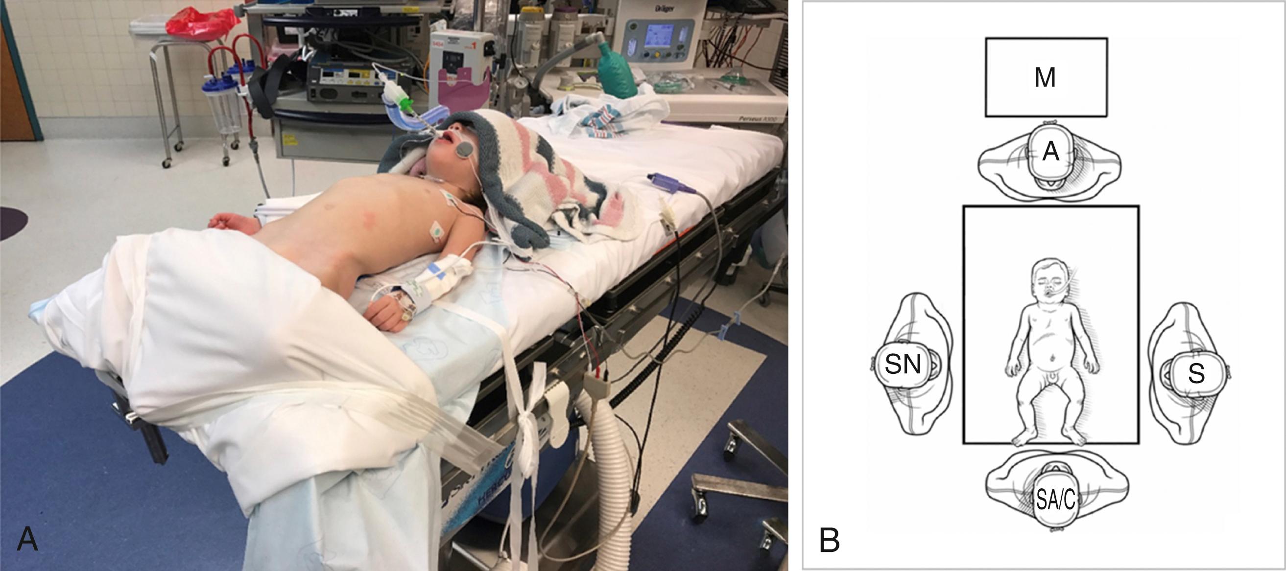 Fig. 4-1, A, The patient is positioned supine on the operating table with arms at sides and general anesthesia is induced. Younger patients are situated at the foot of the bed as seen in the photo B, The surgeon (S) may be positioned on the patient’s left or right or at the foot of the bed, depending on surgeon preference, with the screen located at the head of the bed (M) . The surgical assistant/camera holder (SA/C) is positioned opposite the surgeon or at the foot of the bed. The scrub nurse (SN) is usually across from the surgeon. A, anesthesiologist.