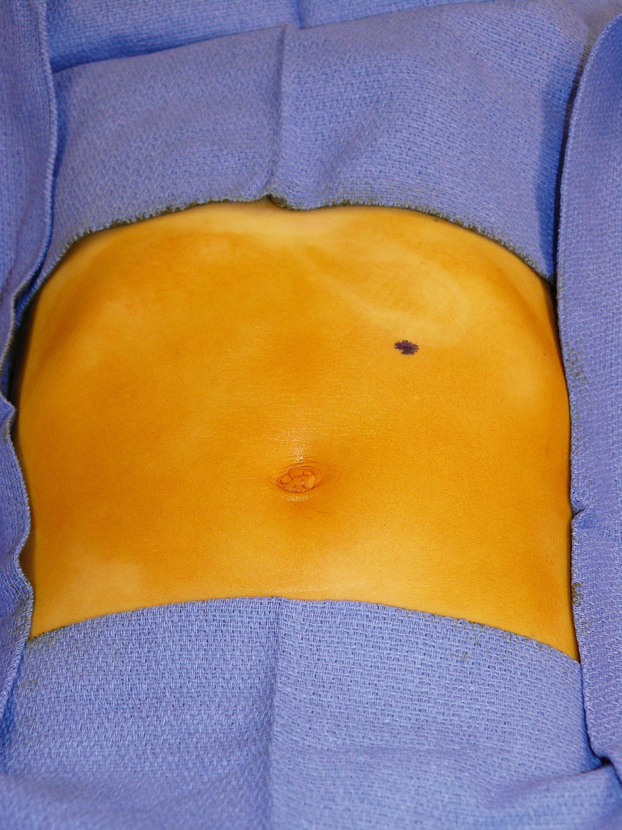 Fig. 4-2, The site on the abdominal wall for the gastrostomy button is marked prior to insufflation.