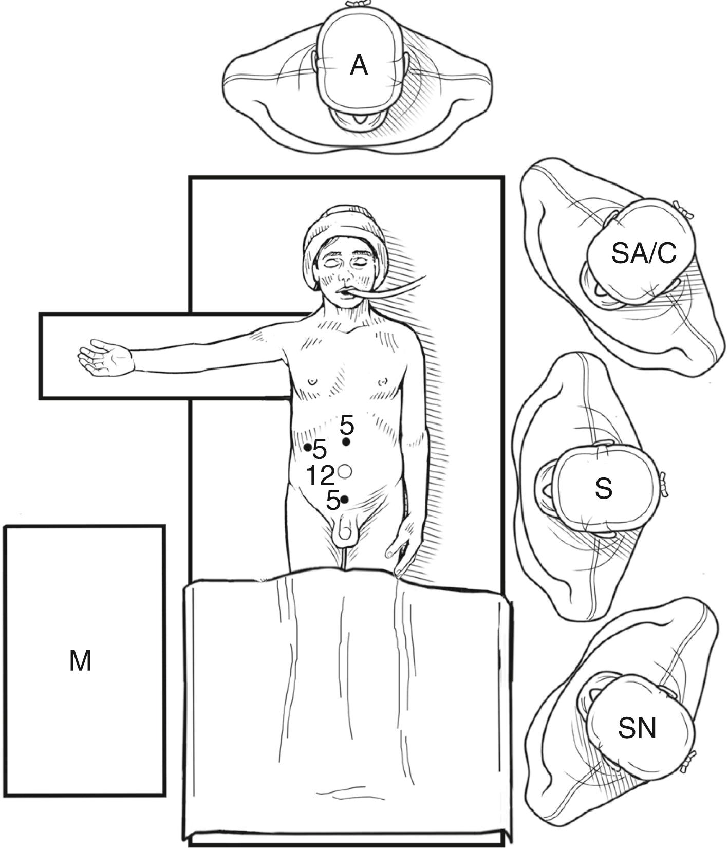 Fig. 8-1, For a traditional laparoscopic ileocecectomy for Crohn disease, the patient is placed supine on the operating table. The surgeon (S) and surgical assistant/camera holder (SA/C) are positioned on the patient’s left side. The viewing monitor (M) is positioned to the right of the patient at the level of the iliac crest. The scrub nurse (SN) is positioned according to surgeon preference. Usually, a 12-mm port is introduced through the umbilicus, which will be the initial port for the telescope/camera, for access for the endoscopic stapler, and for removal of the specimen if an intracorporeal anastomosis is performed or exteriorization of the bowel for an extracorporeal resection/anastomosis. Two or three additional ports are then inserted. Two 5-mm operating ports are positioned, one in the midepigastric area and the other in the suprapubic area. In addition, a 5-mm retraction port can be placed in the patient’s right upper abdomen, if needed. A, anesthesiologist.