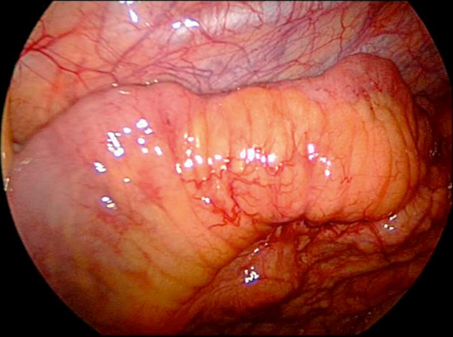 Fig. 8-3, This photograph shows the typical creeping fat of diseased ileum seen at the time of laparoscopic ileocecectomy for Crohn disease.