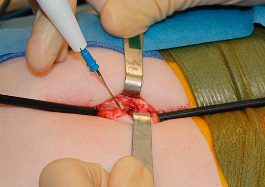 Fig. 8-4, The working instruments at the extremes of the incision can be used as a bridge over which the umbilical fascia is incised.