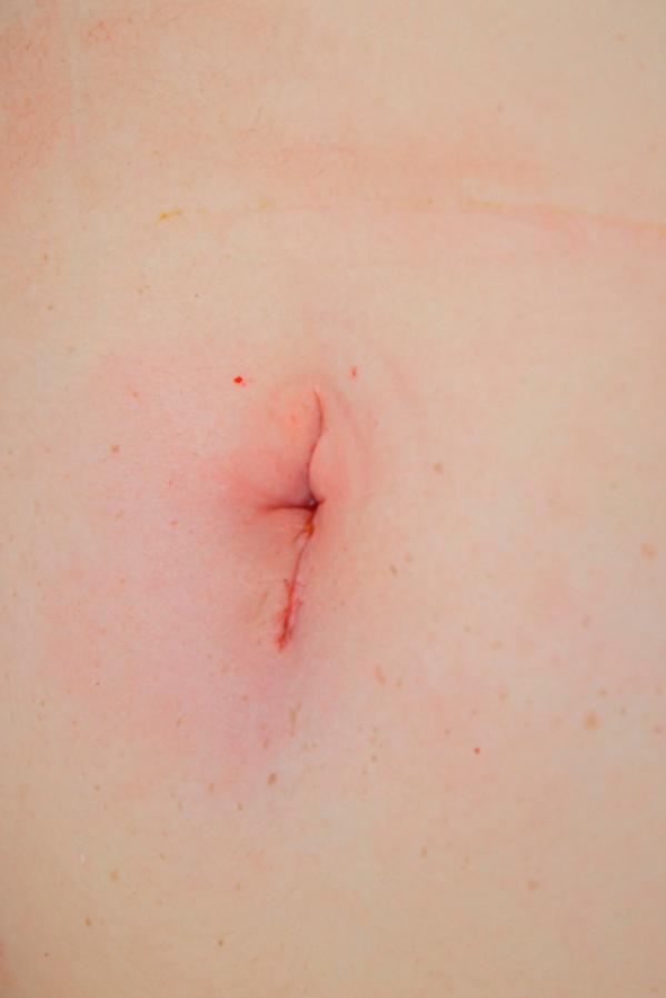 Fig. 8-6, The enlarged umbilical incision is largely hidden within the umbilicus.