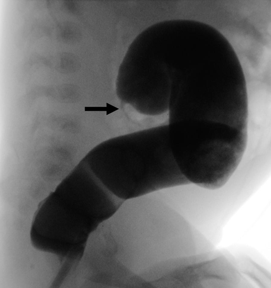 Fig. 12-1, This barium enema identifies a stricture in the left colon ( arrow ) following a medically treated episode of necrotizing enterocolitis.